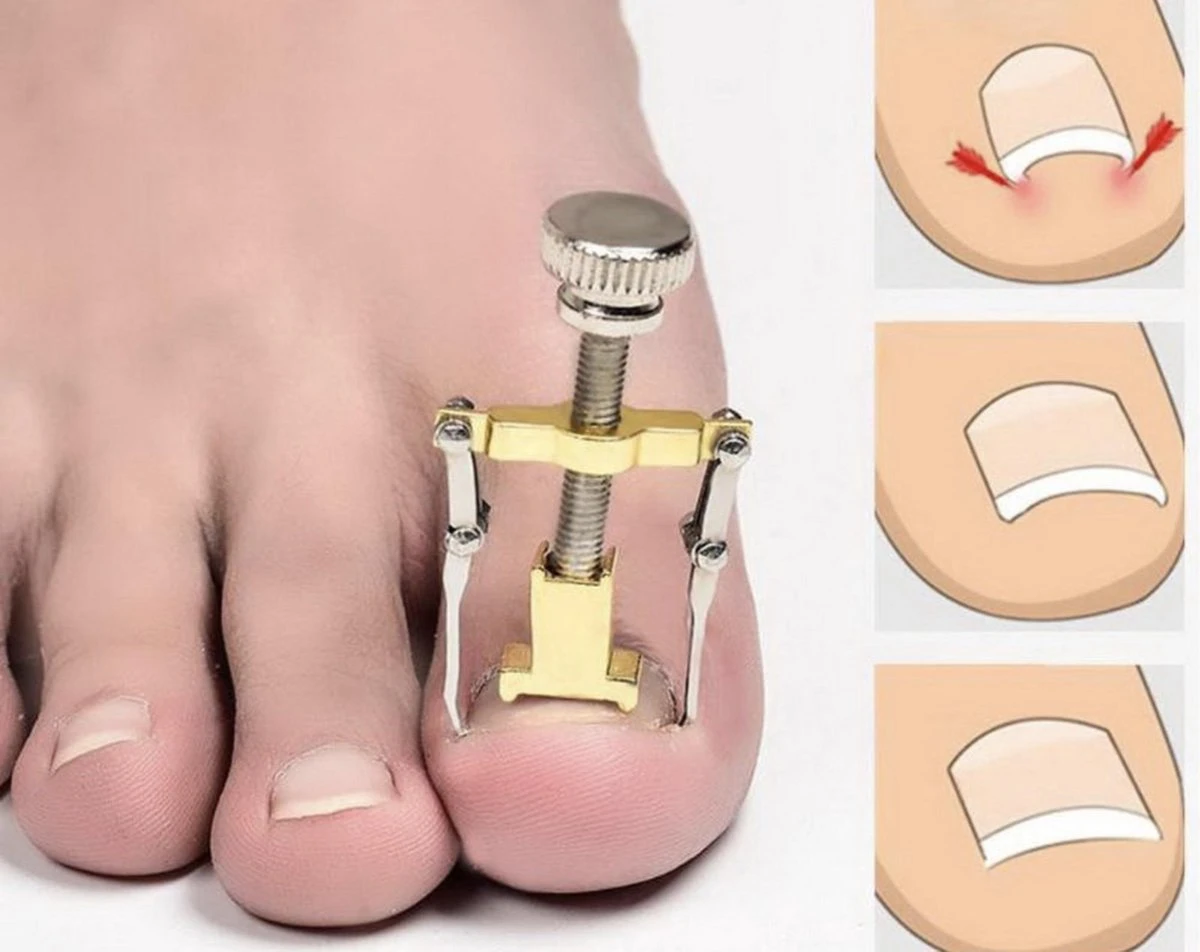 Merkloos Ingegroeide Teennagel Lifter / Corrector | Ingegroeide Vingernagel Vingernagels Teennagels Correctie | Nagel Corrector / Lift 3 Merkloos Ingegroeide Teennagel Lifter / Corrector | Ingegroeide Vingernagel Vingernagels Teennagels Correctie | Nagel Corrector / Lift